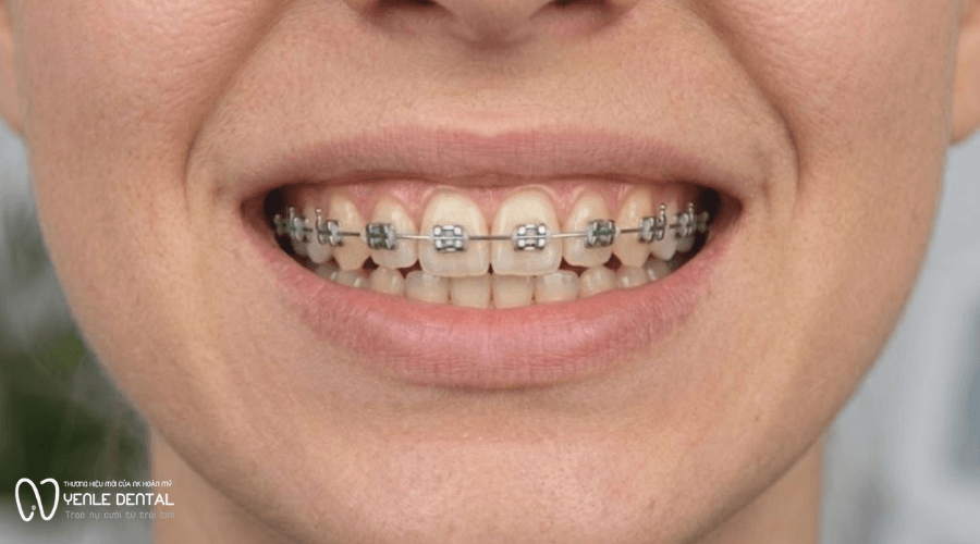 niềng răng một hàm mất bao lâu